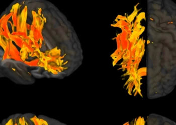 Ερευνητές Εντόπισαν Περιοχές Του Εγκεφάλου Που Επηρεάζονται Από Την Υψηλή Πίεση Και Σχετίζονται Με Την Άνοια