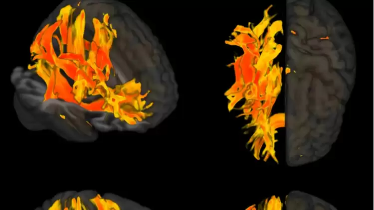 Ερευνητές εντόπισαν περιοχές του εγκεφάλου που επηρεάζονται από την υψηλή πίεση και σχετίζονται με την άνοια
