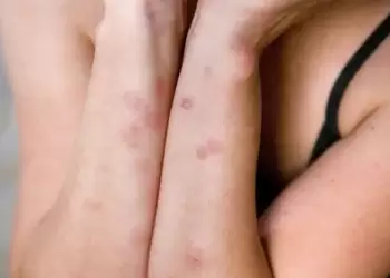 Πώς θα καταλάβετε ότι το σπίτι σας δέχεται «επίθεση» από κοριούς