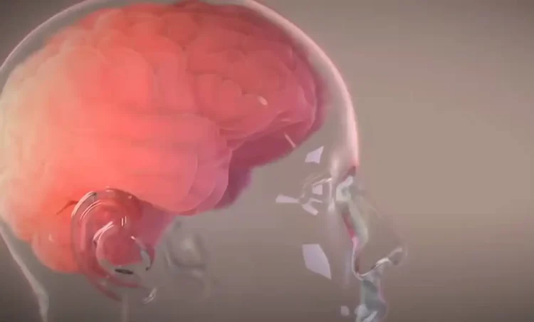 Ο Έλον Μασκ Ανακοίνωσε Την Πρώτη Επιτυχή Εμφύτευση Του Telepathy Σε Εγκέφαλο Ασθενή