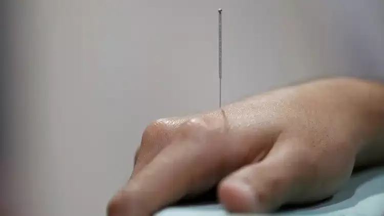 Ο βελονισμός μπορεί να περιορίσει τον κίνδυνο εγκεφαλικού που σχετίζεται με τη ρευματοειδή αρθρίτιδα