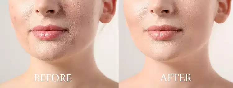 Πώς οι δερματολόγοι μπορούν να βοηθήσουν στην ακμή Πώς οι δερματολόγοι μπορούν να βοηθήσουν στην ακμή