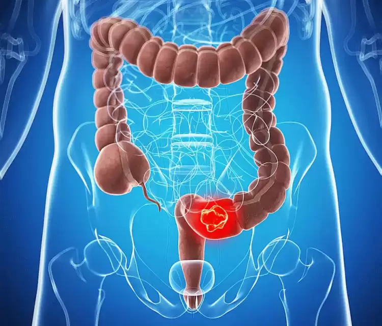 Mε τον όρο καρκίνος παχέος εντέρου εννοούμε το κακόηθες, εκείνο νεόπλασμα, το οποίο αναπτύσσεται στο παχύ έντερο ή στο ορθό. Ο καρκίνος του παχέος εντέρου είναι ένας από τους συχνότερους καρκίνους στον κόσμο.