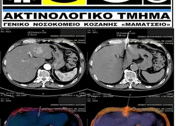 Καθοδηγούμενη Βιοψία Ήπατος στο Ακτινολογικό Τμήμα του νοσοκομείου Κοζάνης