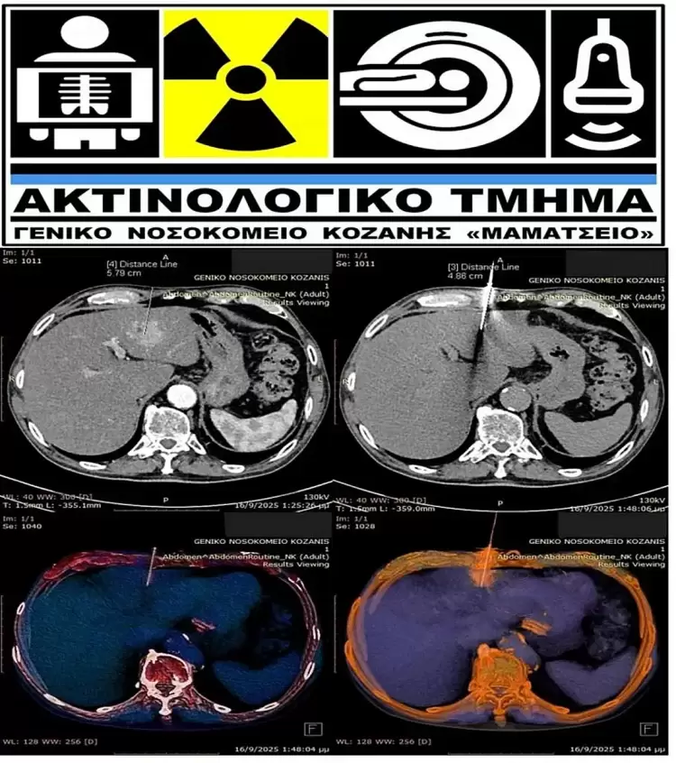 Καθοδηγούμενη Βιοψία Ήπατος στο Ακτινολογικό Τμήμα του νοσοκομείου Κοζάνης Καθοδηγούμενη Βιοψία Ήπατος στο Ακτινολογικό Τμήμα του νοσοκομείου Κοζάνης